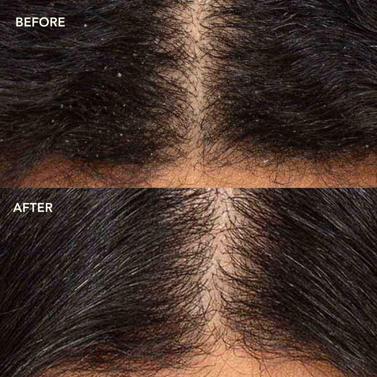 NEEM + SALICYLIC ACID Exfoliating Scalp Serum (Wholesale)