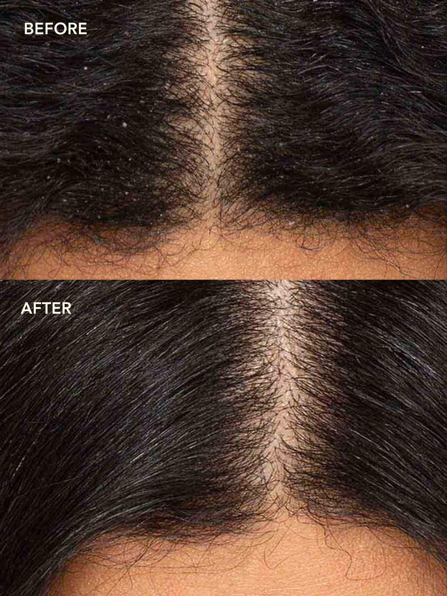 NEEM + SALICYLIC ACID Exfoliating Scalp Serum for Oily, Itchy & Flaky ...